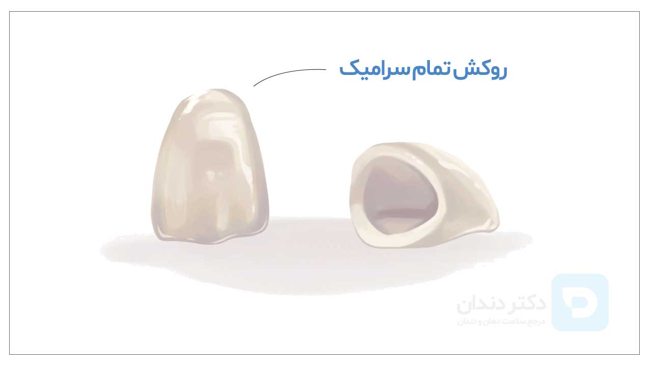 عکس روکش های تمام سرامیکی که برای ترمیم دندان هایی که به شدت پوسیده اند مناسب هستند