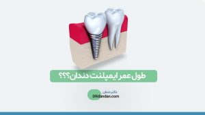 تصویر شاخص و شماتیک از ایمپلنت دندان در کنار دندان طبیعی
