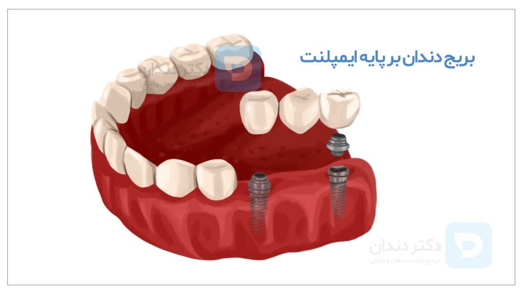 عکس بریج دندان متکی بر ایمپلنت