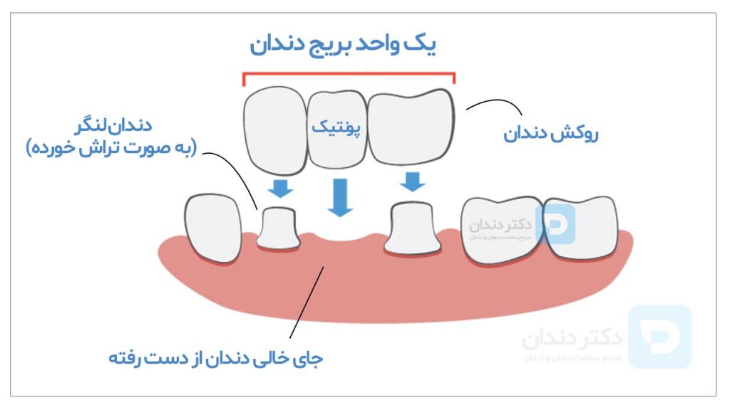 عکس بریج دندان و معرفی بخش های مختلف آن