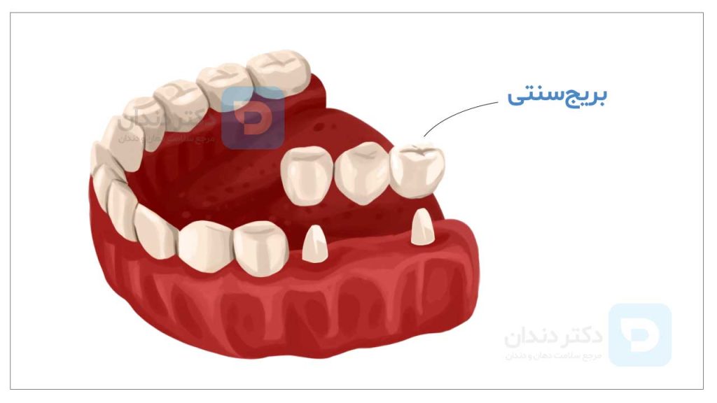 عکس بریج دندان سنتی با دو عدد روکش