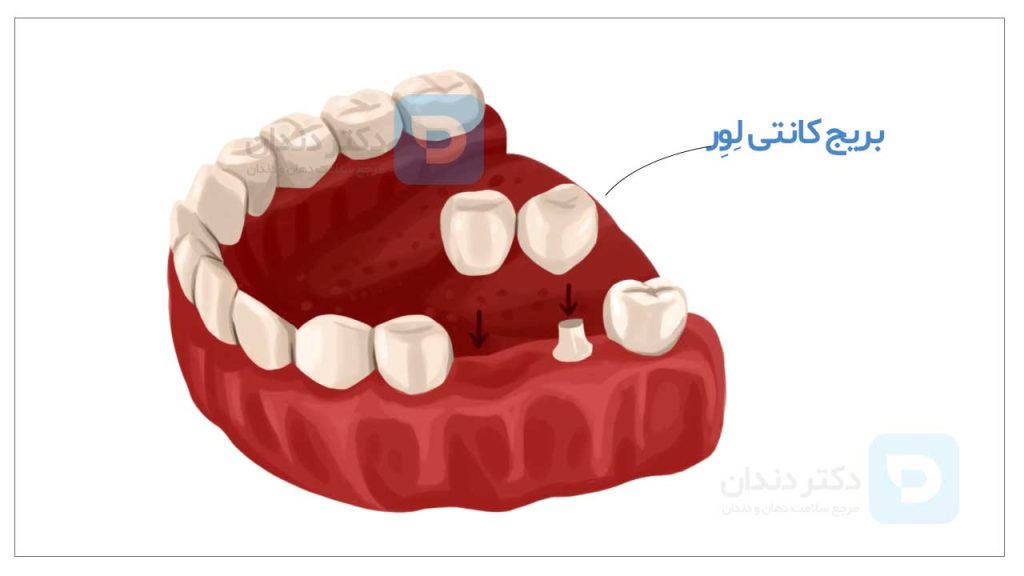 عکس بریج دندان کانتی لور با تراش دندان