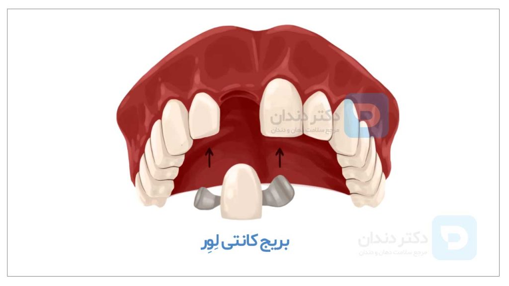 عکس بریج دندان بدون تراش میریلند