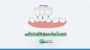 تصویر شاخص بریج دندان