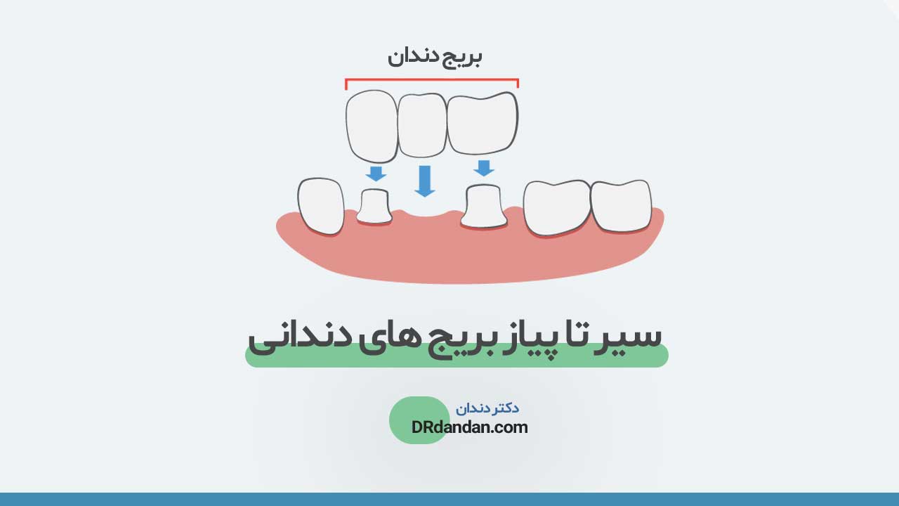 تصویر شاخص بریج دندان