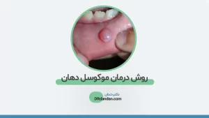 عکس موکوسل دهان