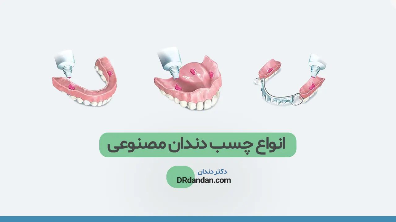 انواع چسب دندان مصنوعی