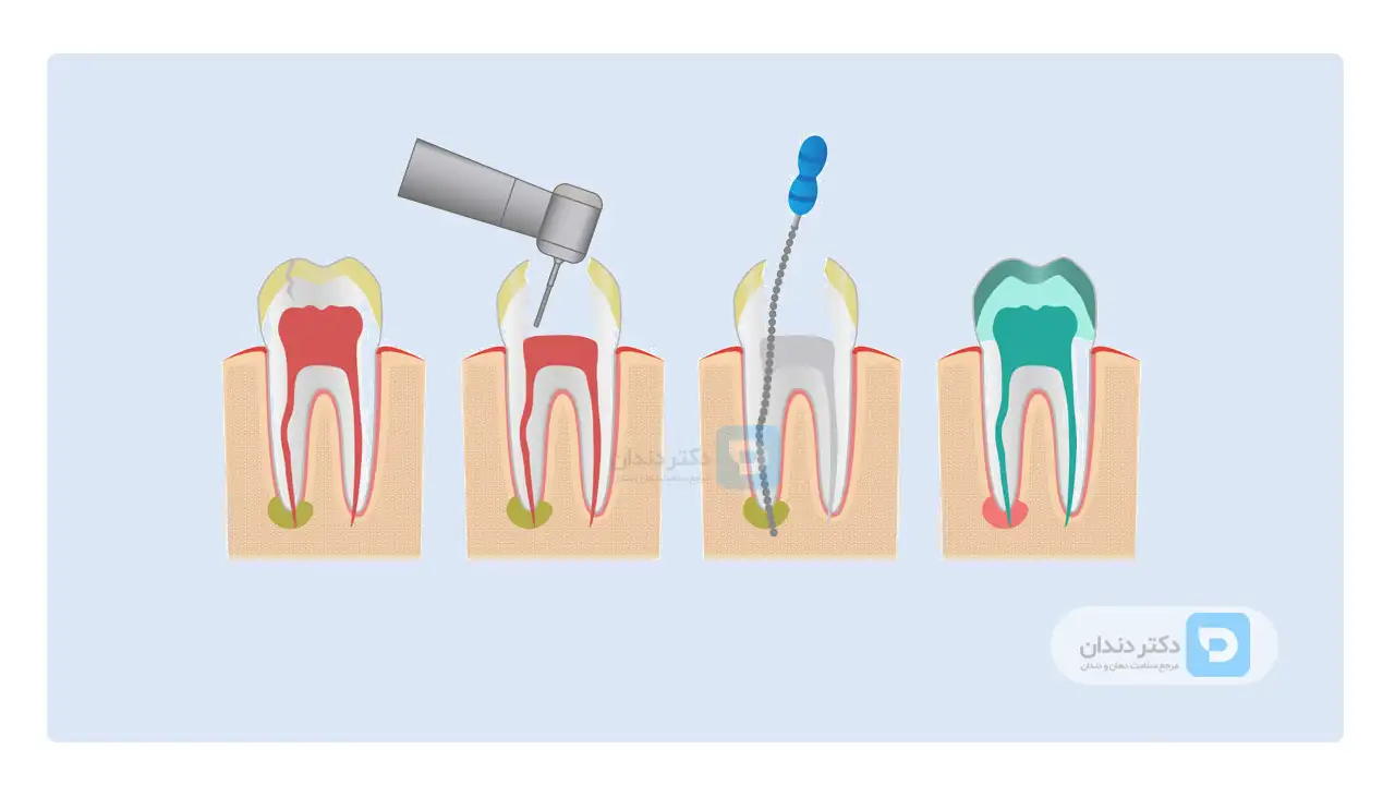 مراحل عصب کشی دندان ها