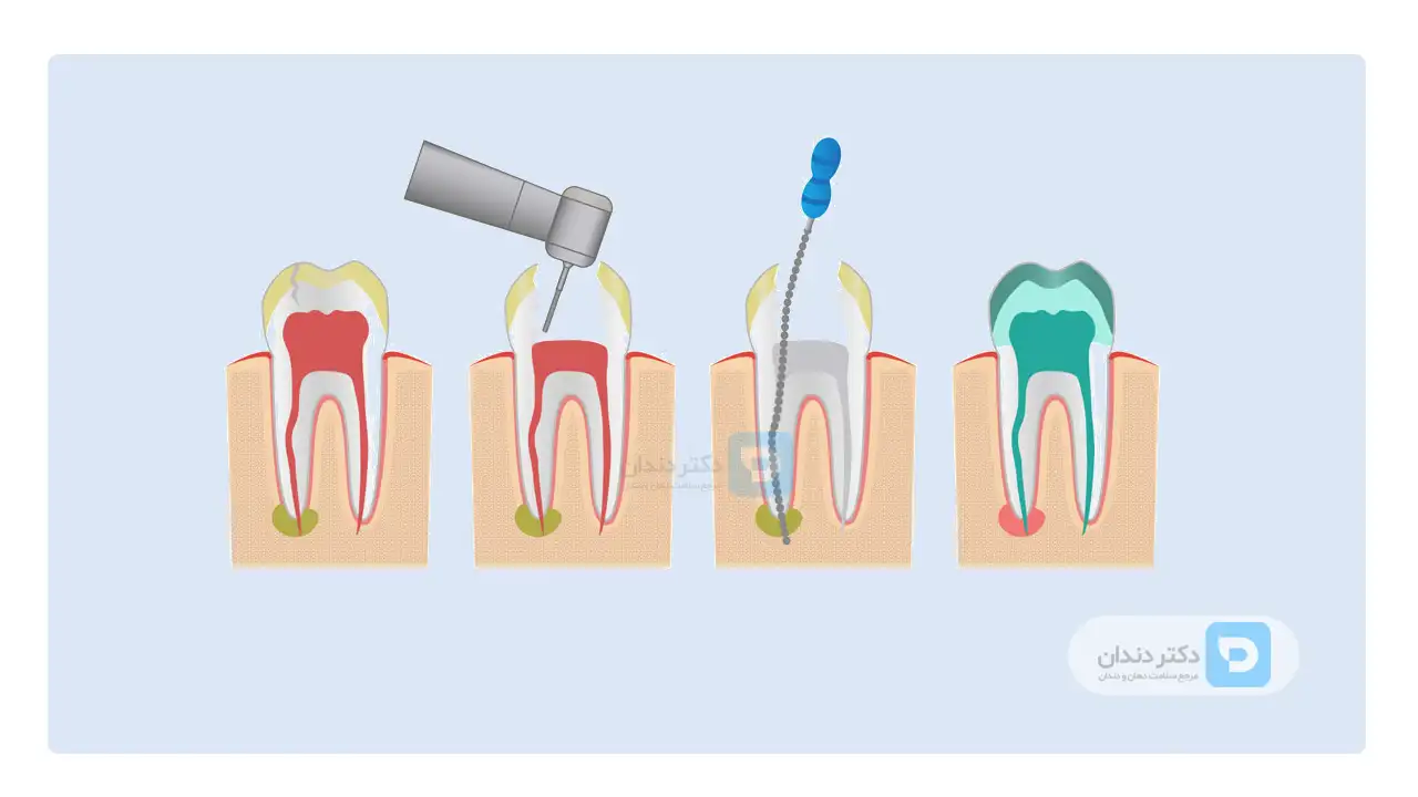 درمان ریشه و عصب کشی دندان