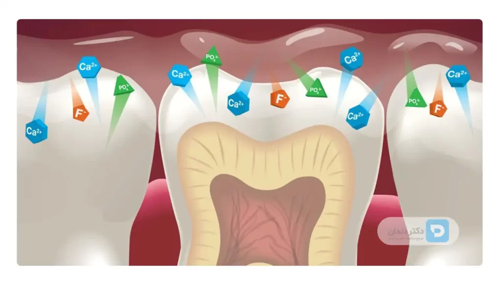 درمان فلورایدتراپی برای کاهش حساسیت دندان ها