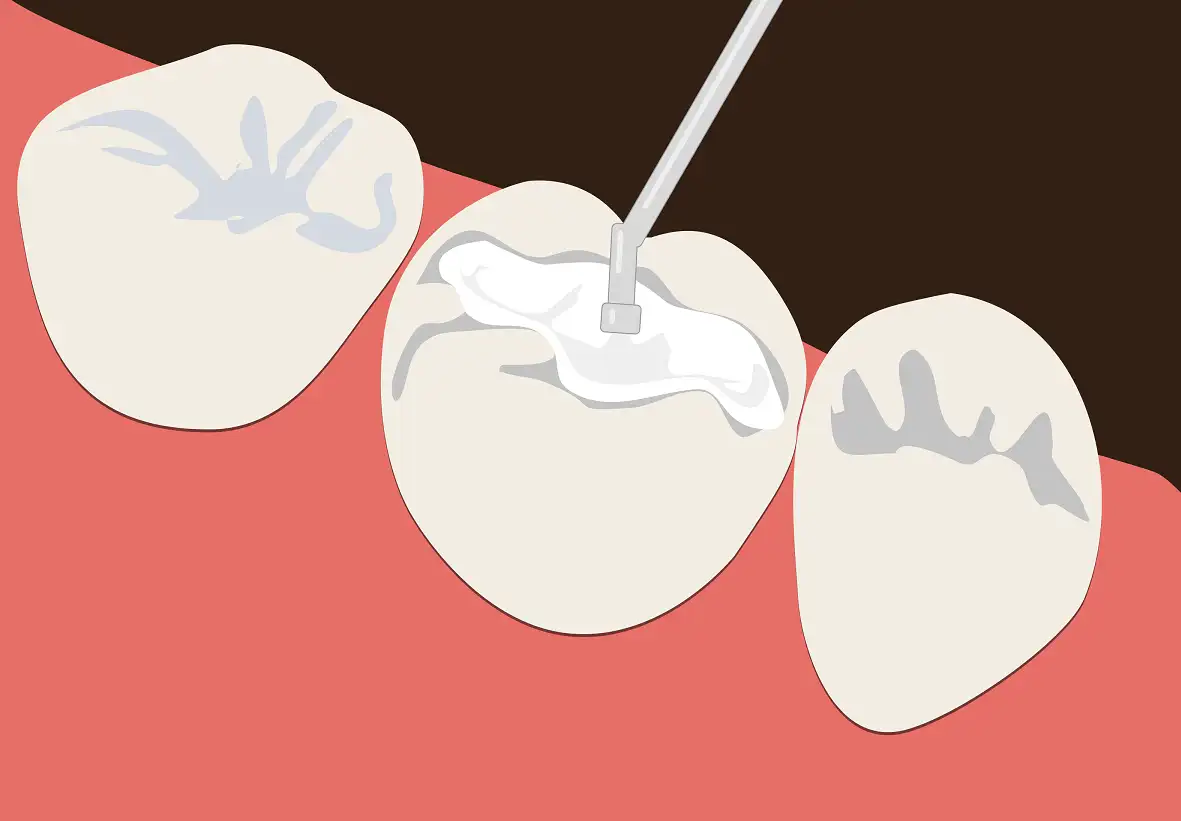 تصویر شماتیک پر کردن دندان با مواد سفید