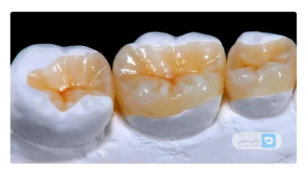 عکس اینله و انله دندان در دندان های خلفی
