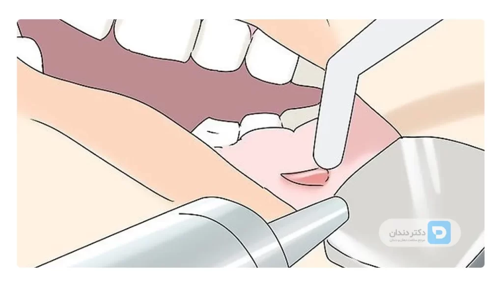 عکس تخلیه آبسه دندان
