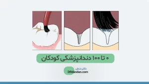 درمان فیشور سیلانت یا شیارپوش