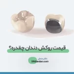 هزینه و قیمت روکش دندان شاخص