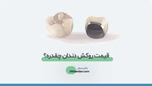 هزینه و قیمت روکش دندان شاخص