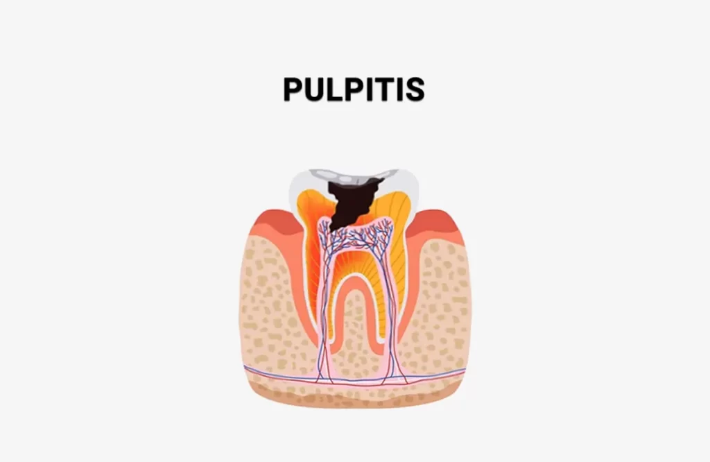 اینفوگرافی عفونت پالپ دندان