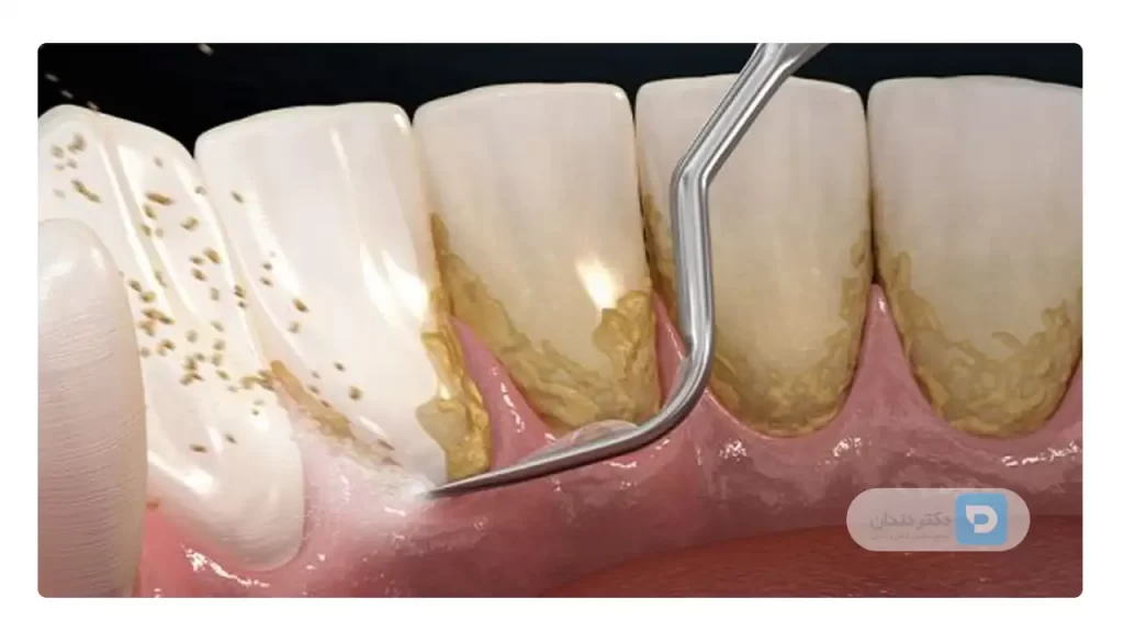 تصویر شماتیک جرمگیری دندان با کمک اسکیلر دستی