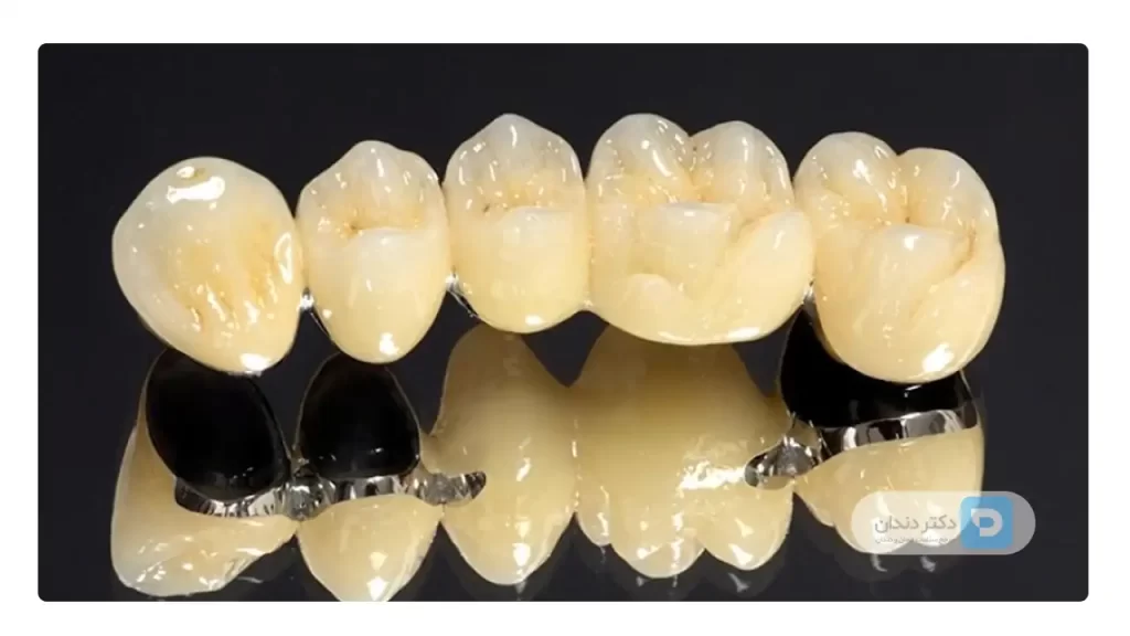 عکس 5 روکش دندان pfm متصل به هم. در اصل یک واحد بریج هست