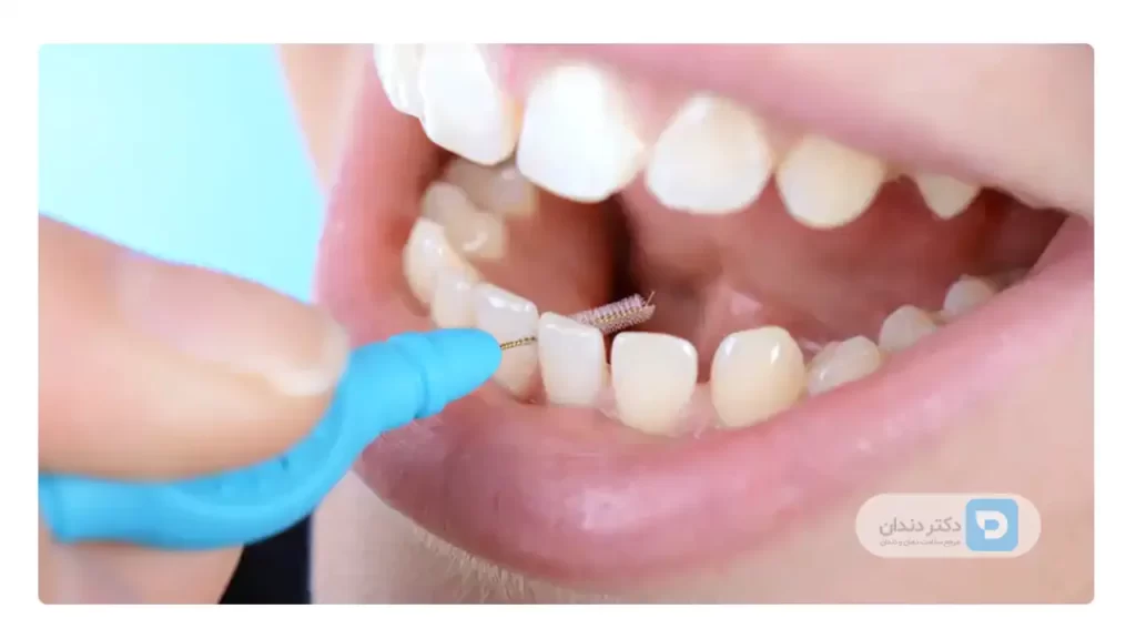 عکس مسواک بین دندانی مورد استفاده برای تمیز کردن بین دندان های روکش شده