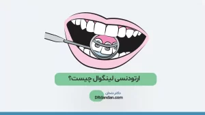 شاخص ارتودنسی لینگوال