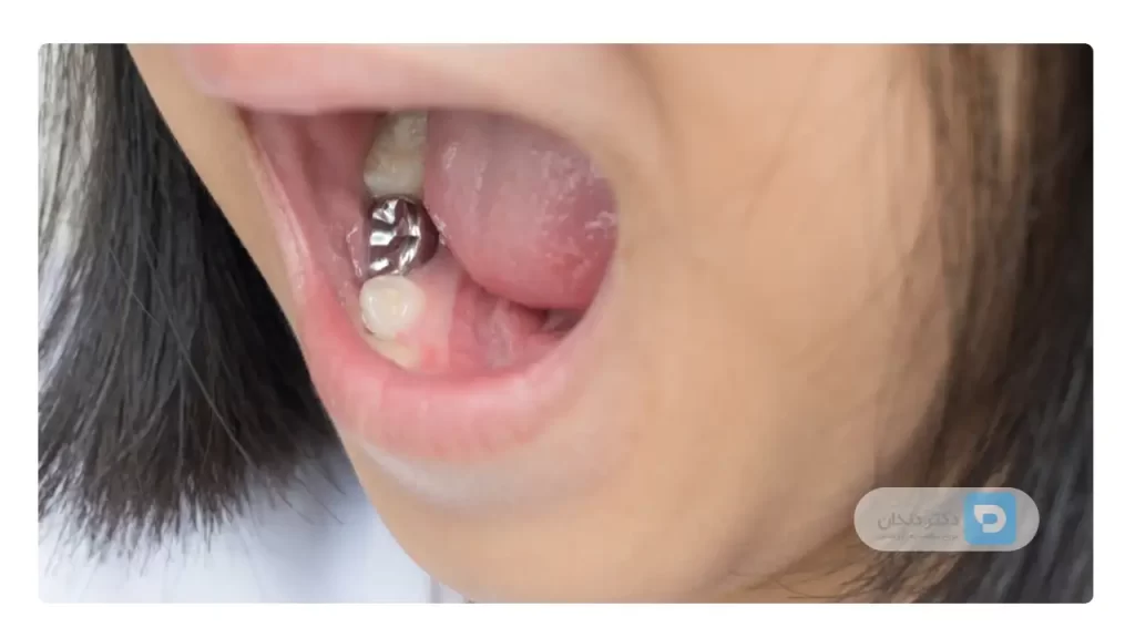 روکش دندان کودکان: در این عکس یکی از دندان های آسیاب روکش شده