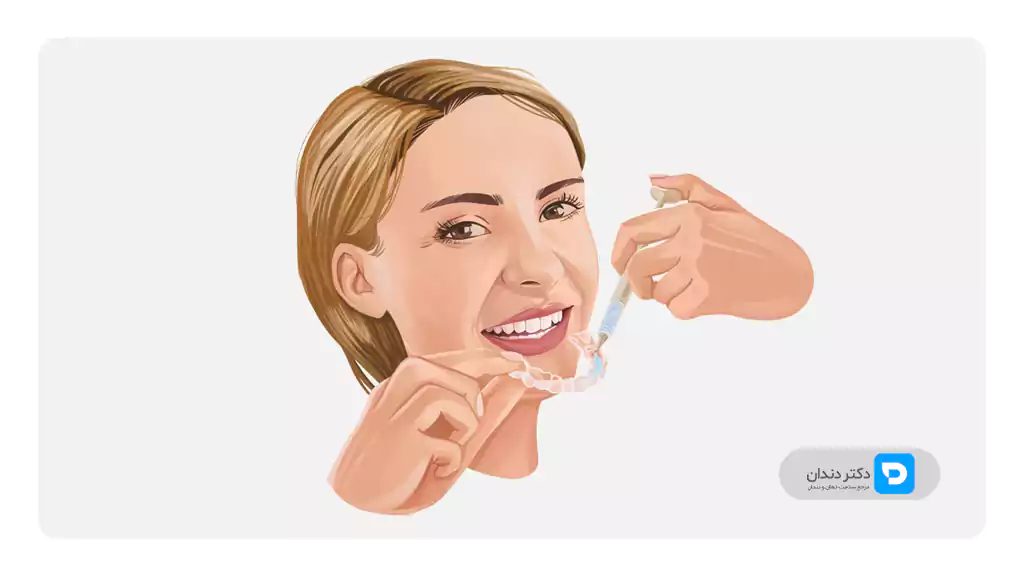 تصویر شماتیک و عکس سفید کردن دندان ها با هوم بلیچینگ