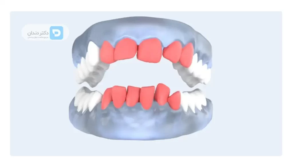 تصویر شماتیک دندان هایی که تا حدی نامرتب هستند. هزینه ارتودنسی دندان های که به صورت جزئی نامرتب هستند کم است