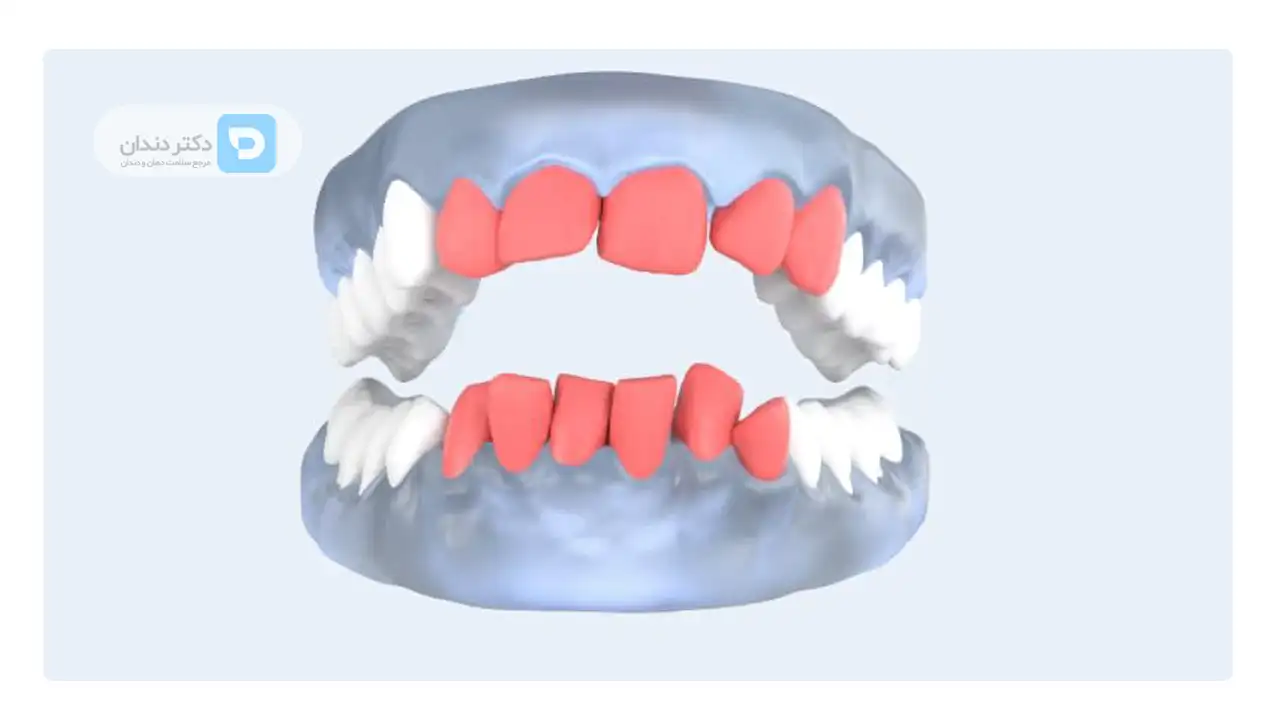 تصویر شماتیک دندان هایی که تا حدی نامرتب هستند. هزینه ارتودنسی دندان های که به صورت جزئی نامرتب هستند کم است