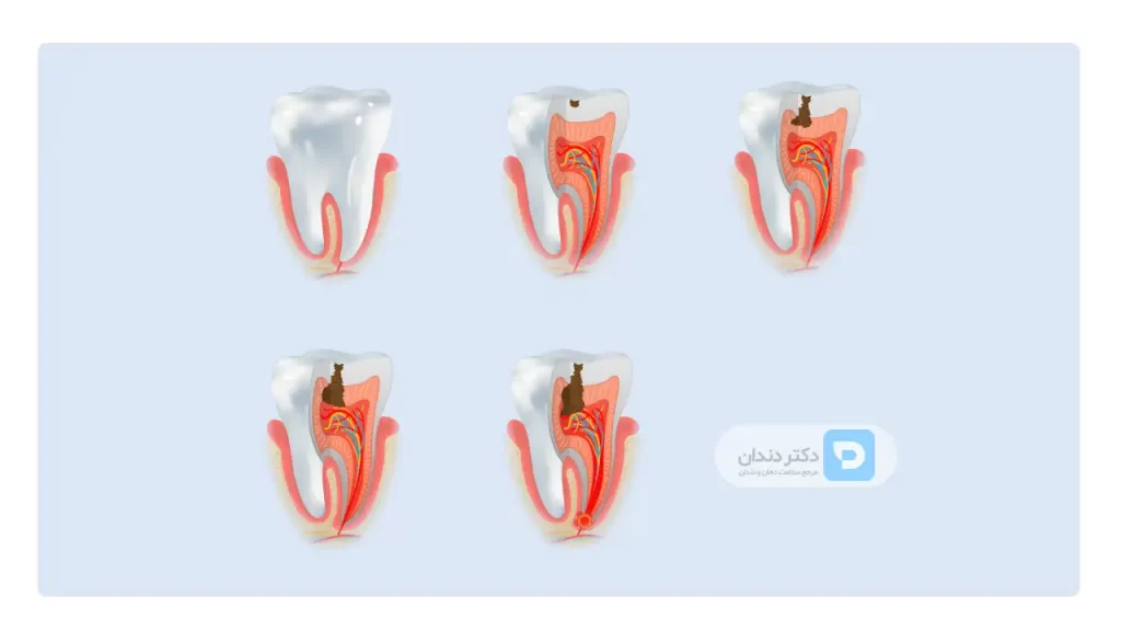 اینفوگرافی مراحل پوسیدگی دندان