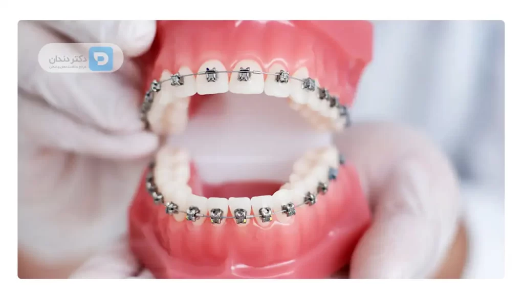 عکس ارتودنسی ثابت دندان