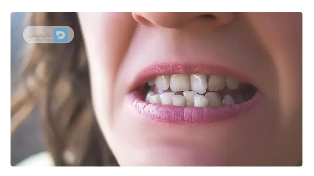 دندان های نامرتب یک خانم که نیاز شدیدی به ارتودنسی دندان دارند
