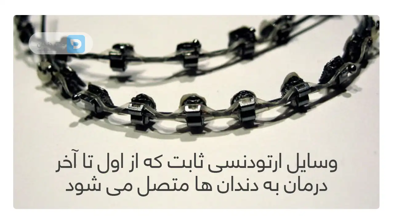 اینفوگرافی ارتودنسی ثابت