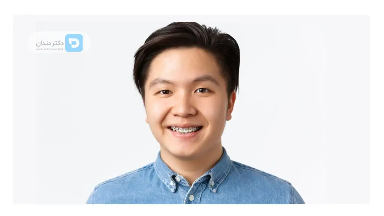 مردی که ارتودنسی ثابت دارد و در حال لبخند زدن است