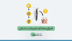 عکس ایمپلنت دندان