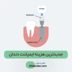 آخرین قیمت و هزینه ایمپلنت دندان