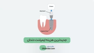 آخرین قیمت و هزینه ایمپلنت دندان