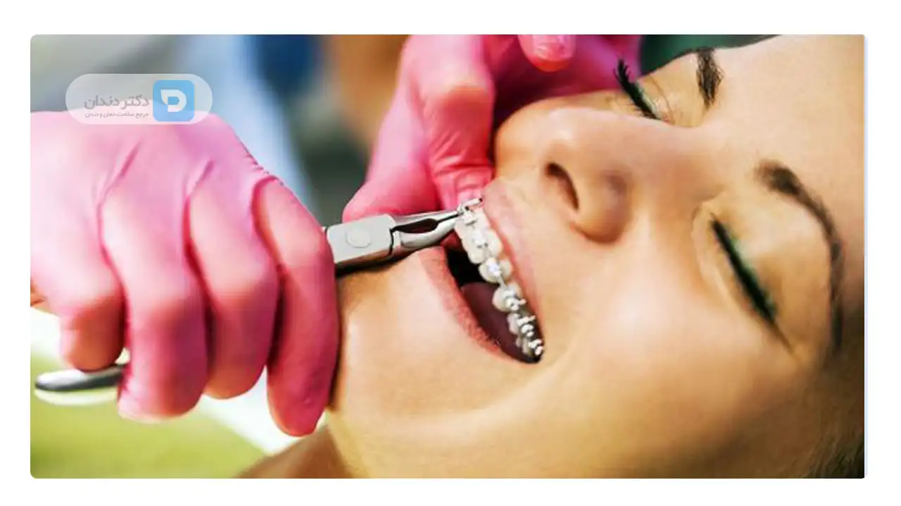 نصب وسایل ارتودنسی ثابت