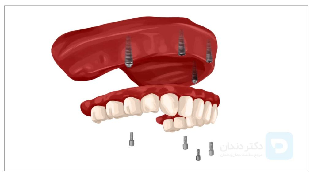 عکس دندان مصنوعی ثابت