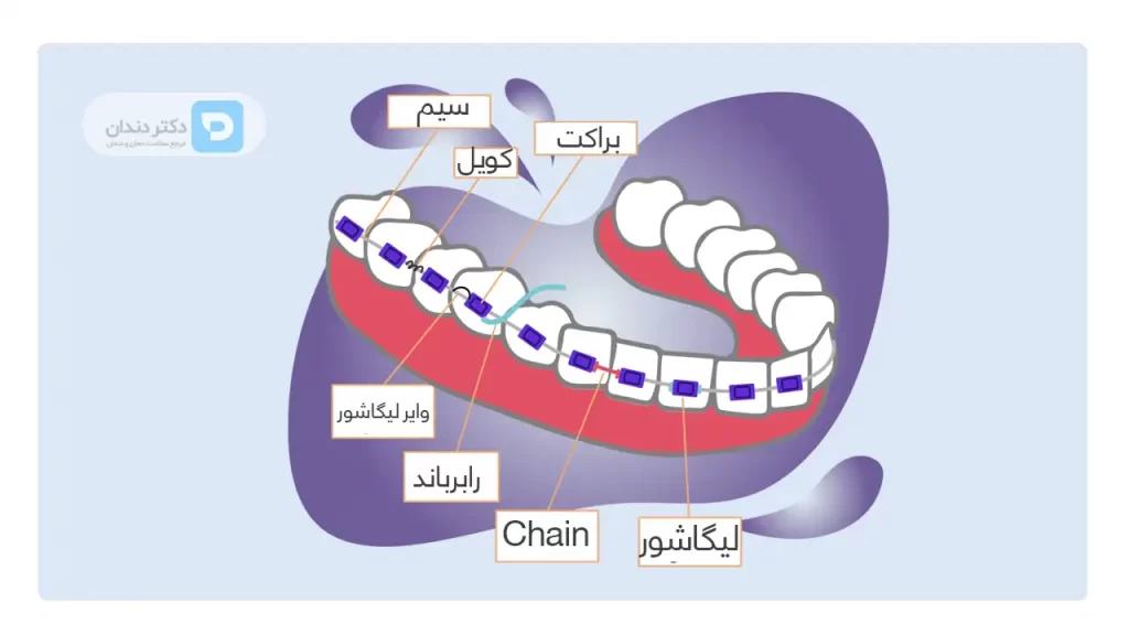 اتصالات مختلف ارتودنسی ثابت که ممکن است با حرکت دادن دندان ها باعث درد ارتودنسی شوند