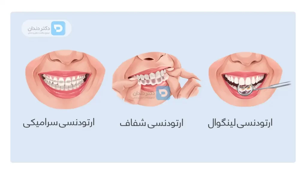 عکس انواع ارتودنسی نامرئی که ممکن است باعث درد ارتودنسی شوند