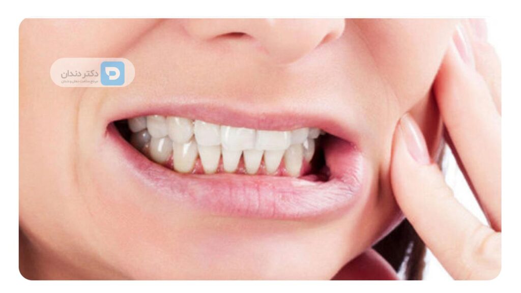 دندان قروچه (براکسیسم) چیست؟