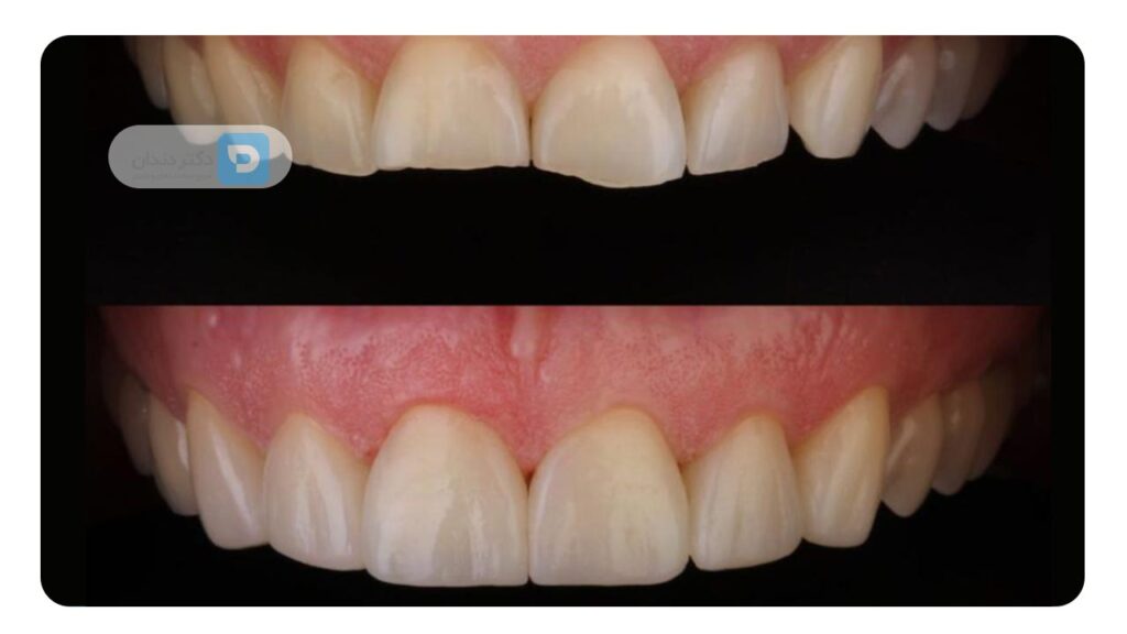 فرسایش مینای دندان