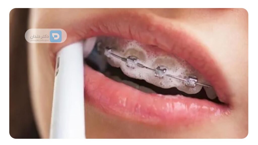 مسواک زدن با مسواک نرم ،حتی در روزهای دردناک