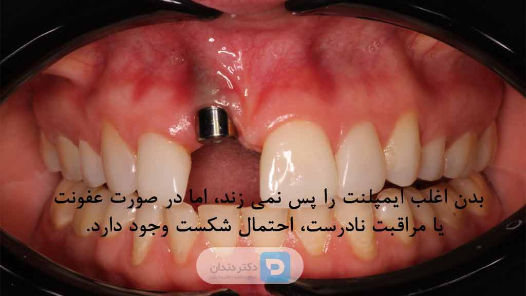 پس زدن ایمپلنت