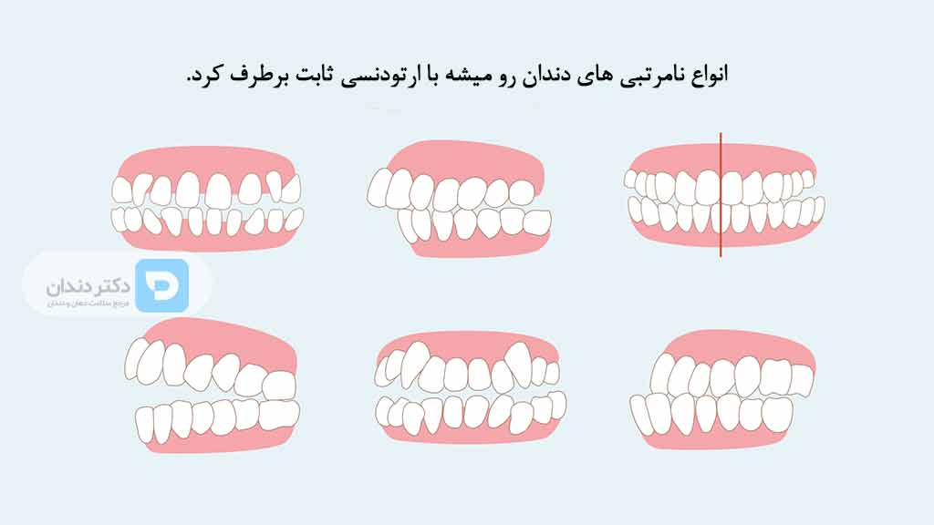 انواع نامرتبی های دندان