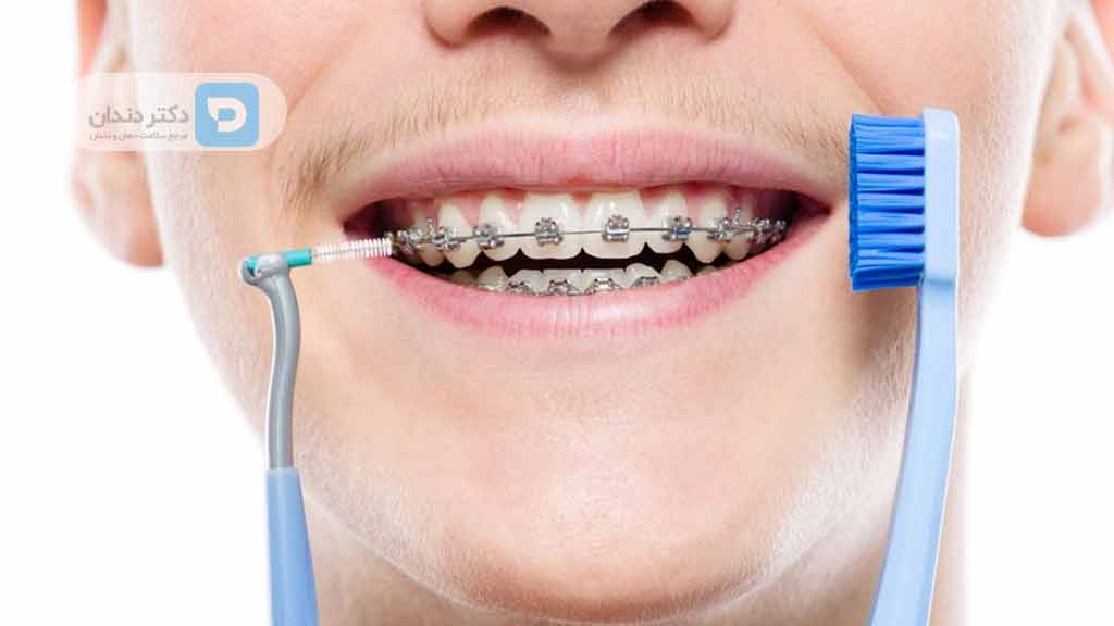 تمیز کردن بریس ها