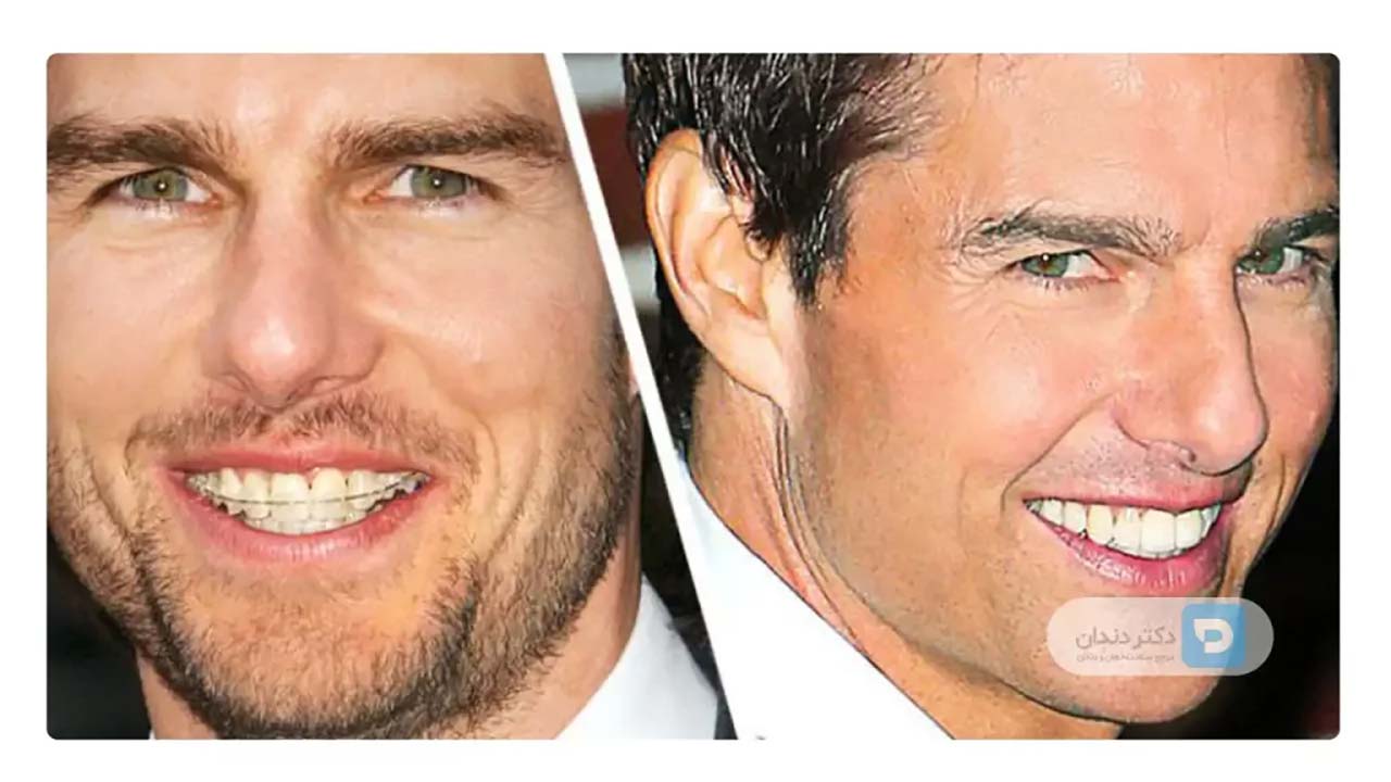 ارتودنسی ثابت سرامیکی