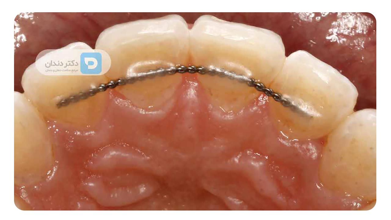  نگهدارنده ثابت ارتودنسی