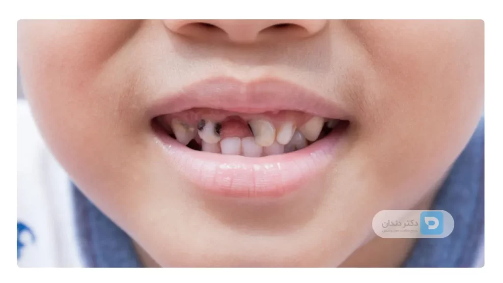 درمان دندان درد کودکان ناشی از پوسیدگی دندان